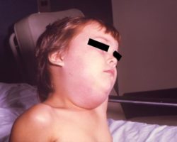 Mumps causes swelling under the jaw.