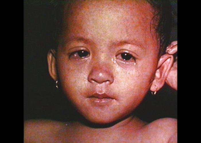 a child with measles